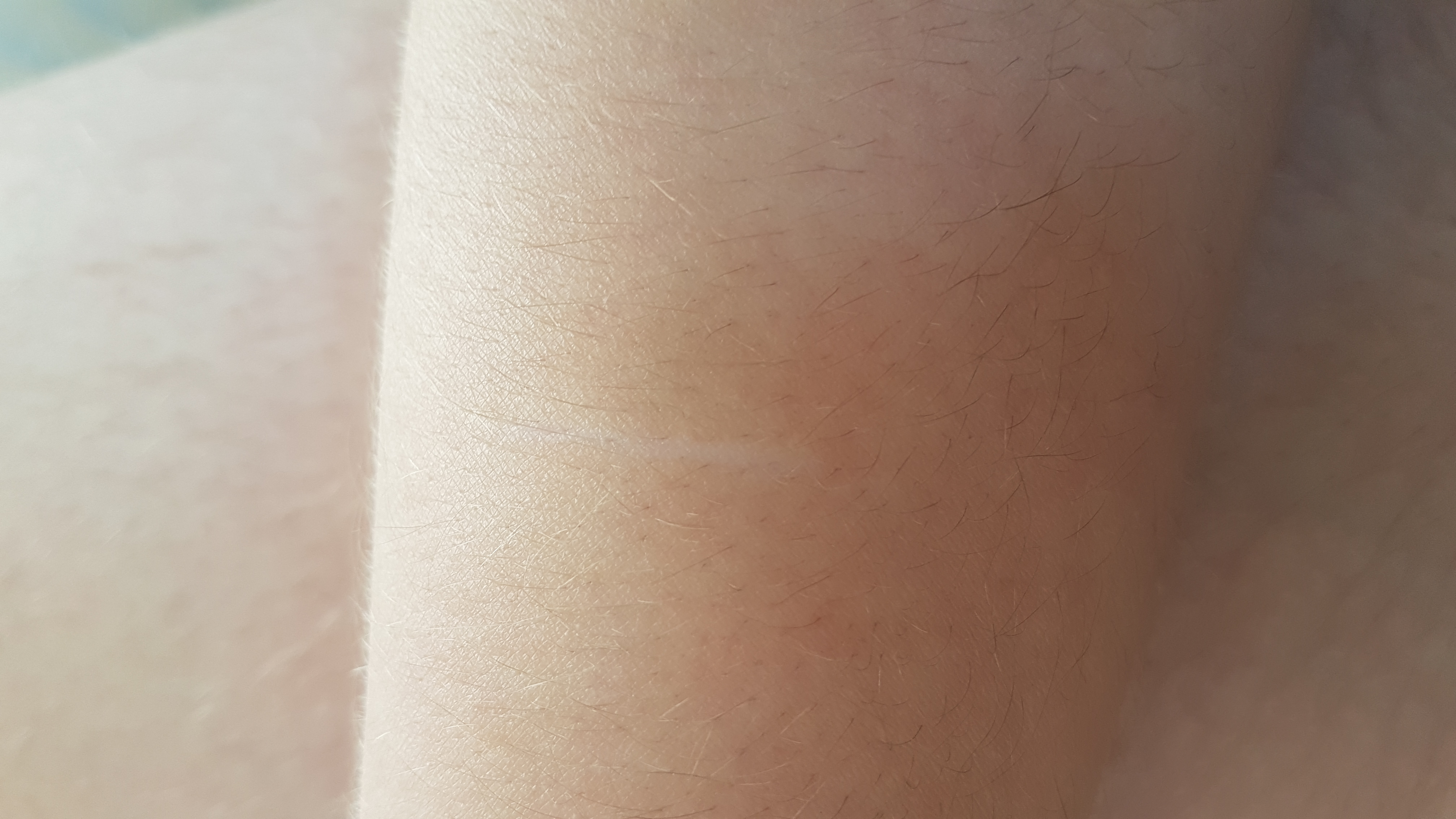 Weißer Strich am Arm was ist