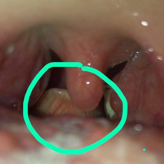 Weisses Ding Im Rachen Gesundheit Und Medizin Gesundheit Arzt Weisses Ding Im Rachen Gesundheit Und Medizin Gesundheit Arzt