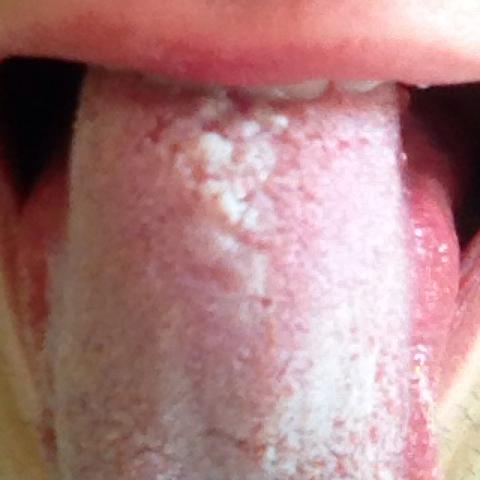 Weißes Geschwürr auf der Mitte der Zunge - (Gesundheit, Medizin, Arzt)
