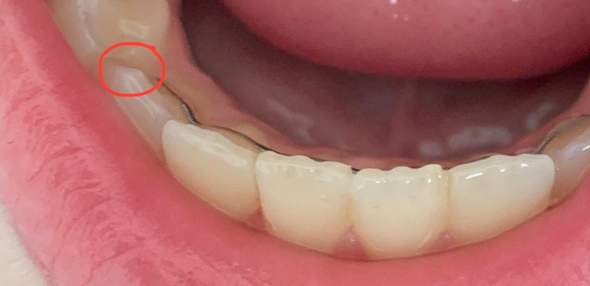 Weißfärbung an Zahn und Zahnschmerzen, ist das Karies?