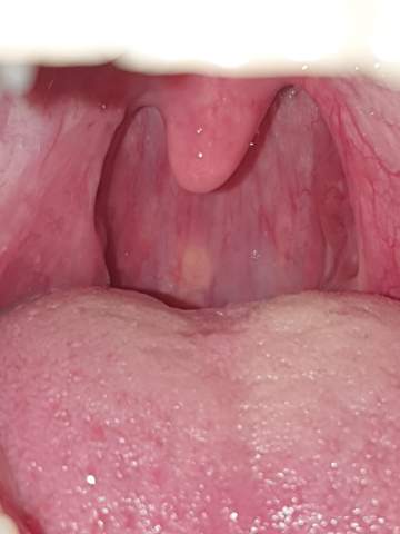 Weiss Gelber Fleck Im Rachen Hilfe Gesundheit Und Medizin Gesundheit Weiss Gelber Fleck Im Rachen Hilfe Gesundheit Und Medizin Gesundheit