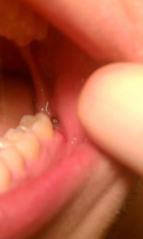 Loch hinter naht - (Zähne, Zahnarzt, Operation)