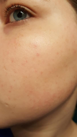 Welche Art Pickel Ist Das Haut Welche Art Pickel Ist Das Haut