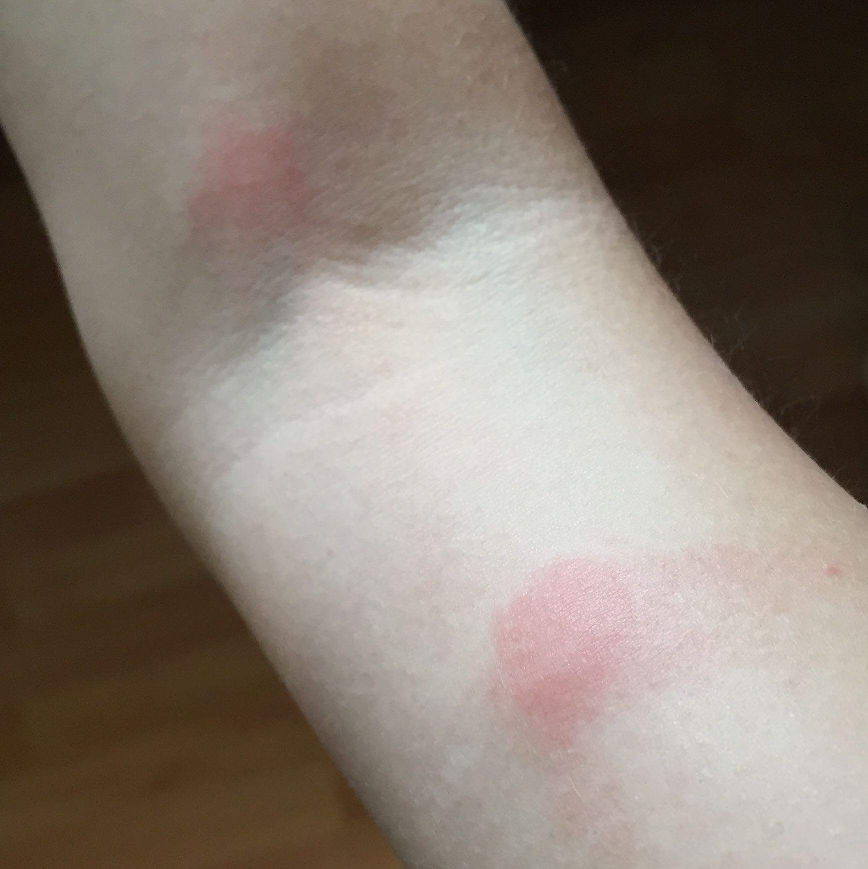 Welche Art Stich Ist Das Mucken Milben Bettwanzen Welche Art Stich Ist Das Mucken Milben Bettwanzen