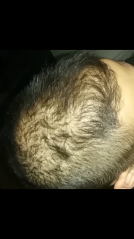 Welche Art von Haarausfall habe ich? Diffus oder erblich? Was tun ...