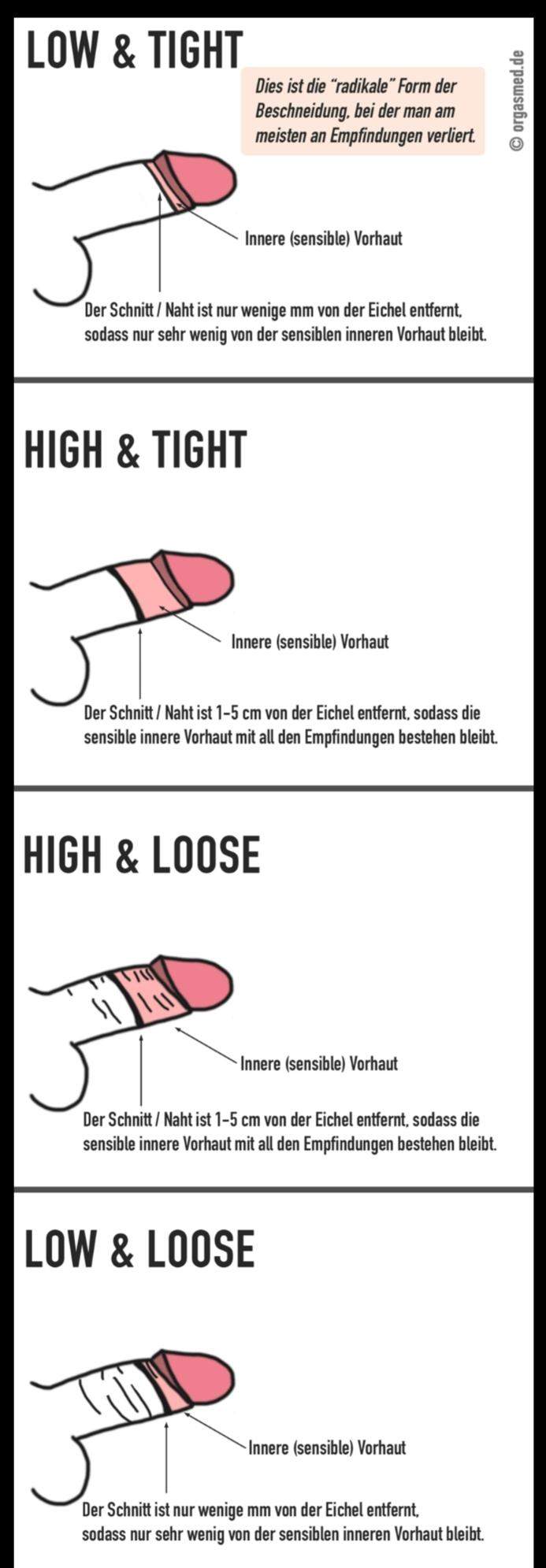 Welche beschneidung? (Penis, beschnitten, beschnittener Mann) Welche beschneidung? (Penis, beschnitten, beschnittener Mann)