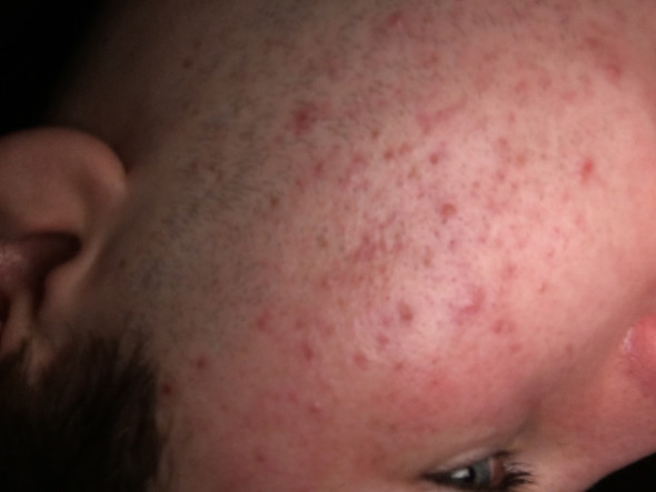 Welche Creme Vom Hautarzt Oder Einfach So In Der Apotheke Hilft Am Allerbesten Gegen Akne