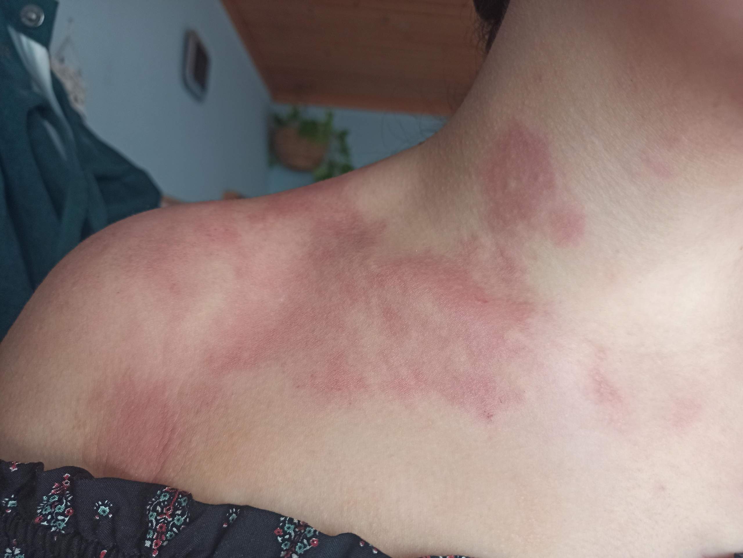 Welche Hautkrankheit könnte das sein (Neurodermitis?)? (Gesundheit und