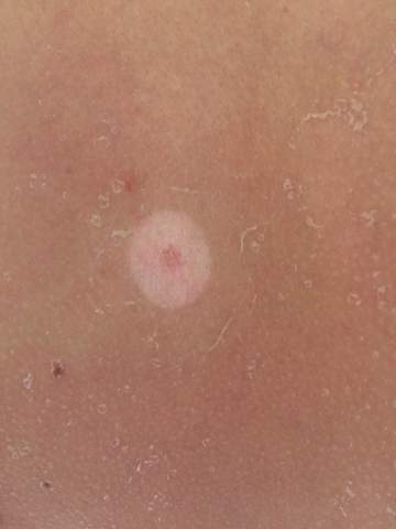 Welche Ursachen kann ein weißer sich ausbreitender Hautfleck nach einem Welche Ursachen kann ein weißer sich ausbreitender Hautfleck nach einem