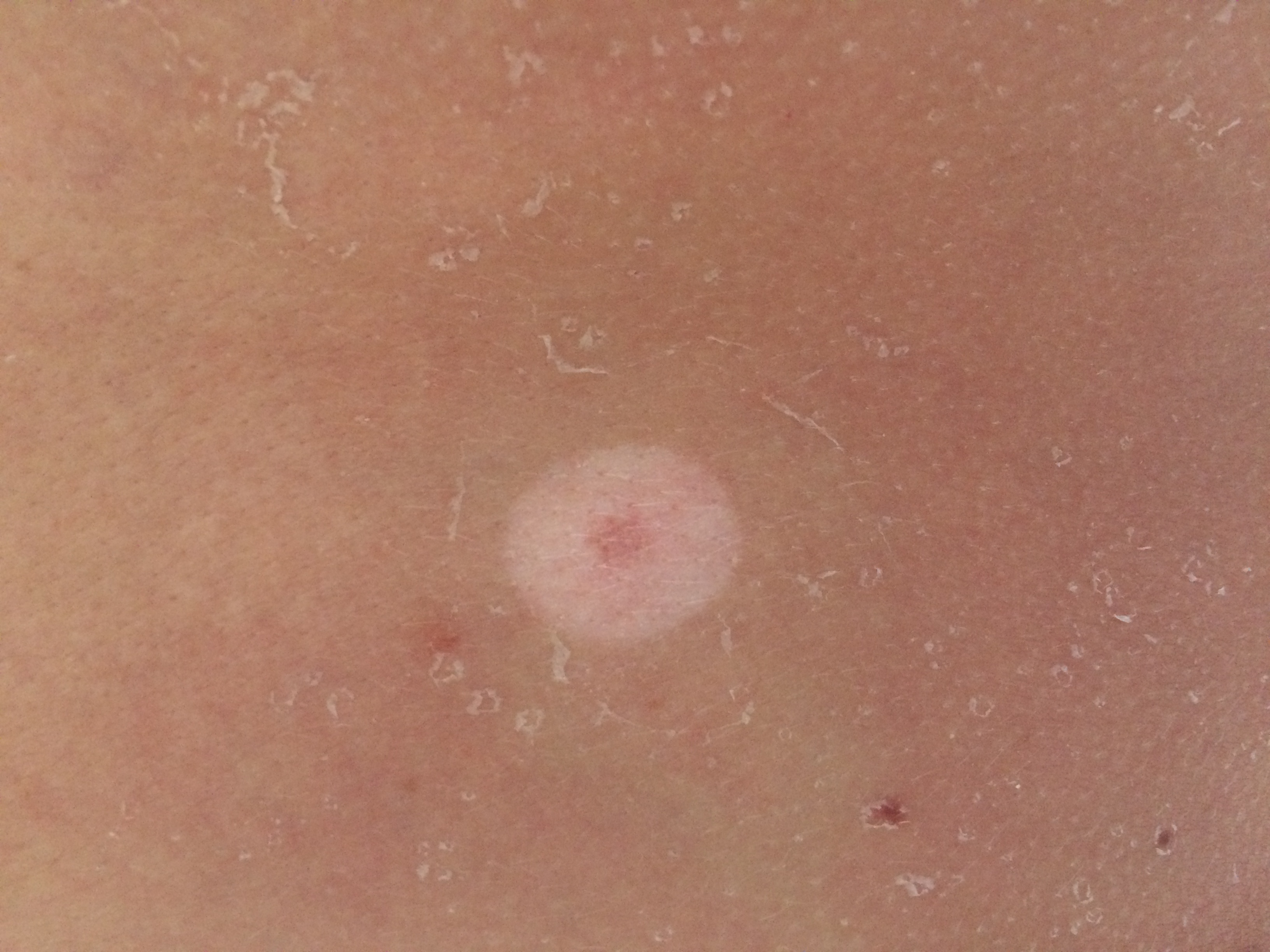 Welche Ursachen kann ein weißer sich ausbreitender Hautfleck nach einem Welche Ursachen kann ein weißer sich ausbreitender Hautfleck nach einem