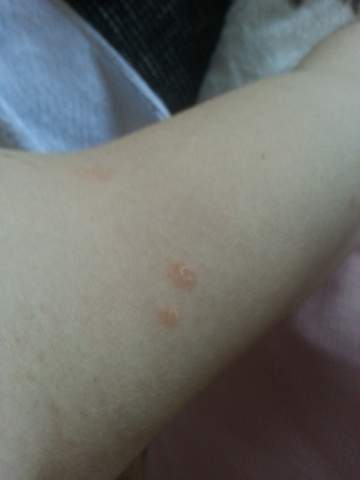 Welcher Hautpilz Ist Das Gesundheit Und Medizin Gesundheit Welcher Hautpilz Ist Das Gesundheit Und Medizin Gesundheit