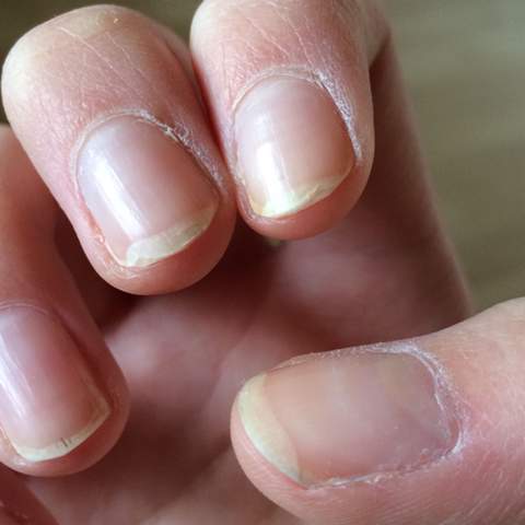 Welcher Mangel Bei Solchen Fingernageln Gesundheit Ernahrung Korper Welcher Mangel Bei Solchen Fingernageln Gesundheit Ernahrung Korper