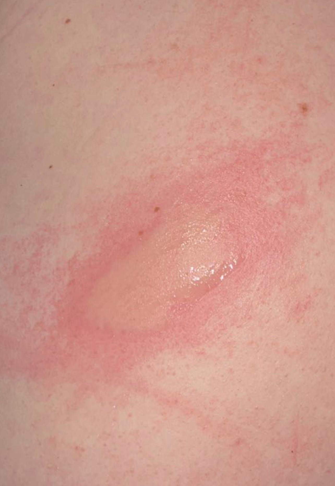 Welches Tier beißt mich seit Monaten nachts? (Ungeziefer, beißen)