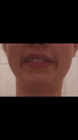 Wenn Ich Lachle Hab Ich So Mundwinkel Falten Die Unter Dem Bereich Des Mundwinkelbereichs Geht Kann Meine Mundwinkel Nicht Nach Oben Ziehen Normal Od Op Lachen Schonheitsoperation