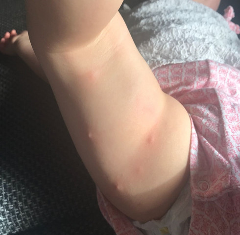 Wer Kann Mir Sagen Was Das Fur Stiche Bisse Sind Kinder Baby