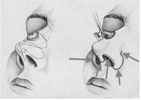 Mediane Nasenrückenfistel - (Medizin, Nase)
