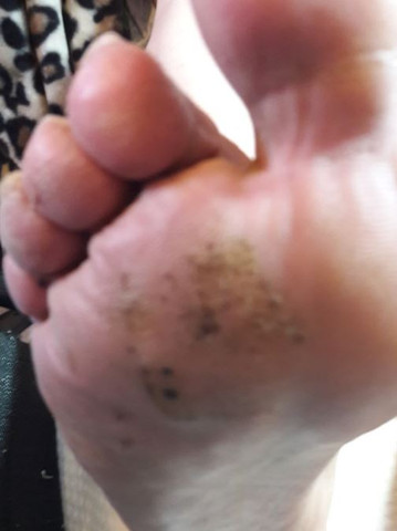 Die Fußnägel sind anscheinend völlig krümelig - (Hautarzt, Fußpilz)