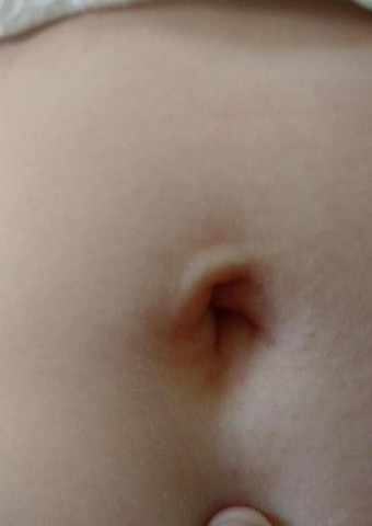 Wer Von Euch Erkennt Einen Nabelbruch Gesundheit Und Medizin Medizin Bauch Wer Von Euch Erkennt Einen Nabelbruch Gesundheit Und Medizin Medizin Bauch