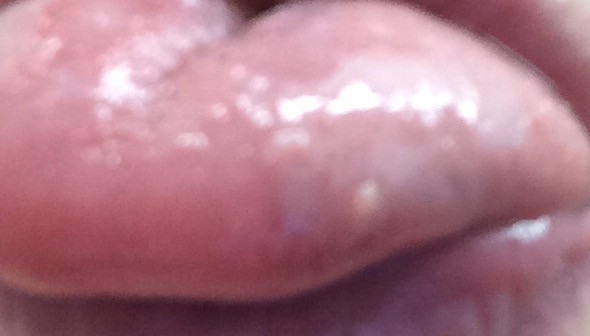 Get Pickel Auf Der Zunge Corona Background