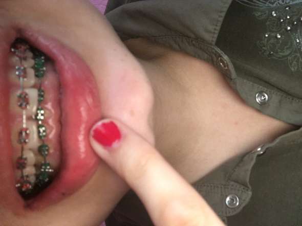 Werde Ich Schone Zahne Bekommen Mithilfe Einer Feste Zahnspange