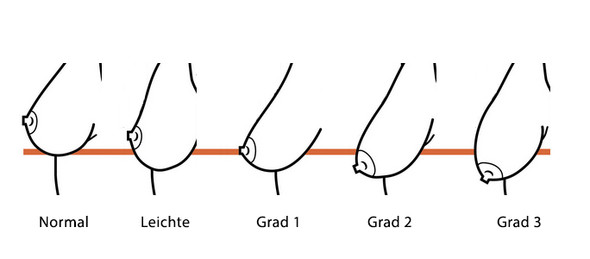 Werden Hangende Bruste Nach Der Abnahme Schlimmer Oder Besser Gesundheit Und Medizin Gesundheit Sport Werden Hangende Bruste Nach Der Abnahme Schlimmer Oder Besser Gesundheit Und Medizin Gesundheit Sport
