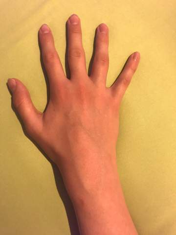 Werden meine Hände und Handgelänke größer? (Pubertät, Wachstum, Hand)