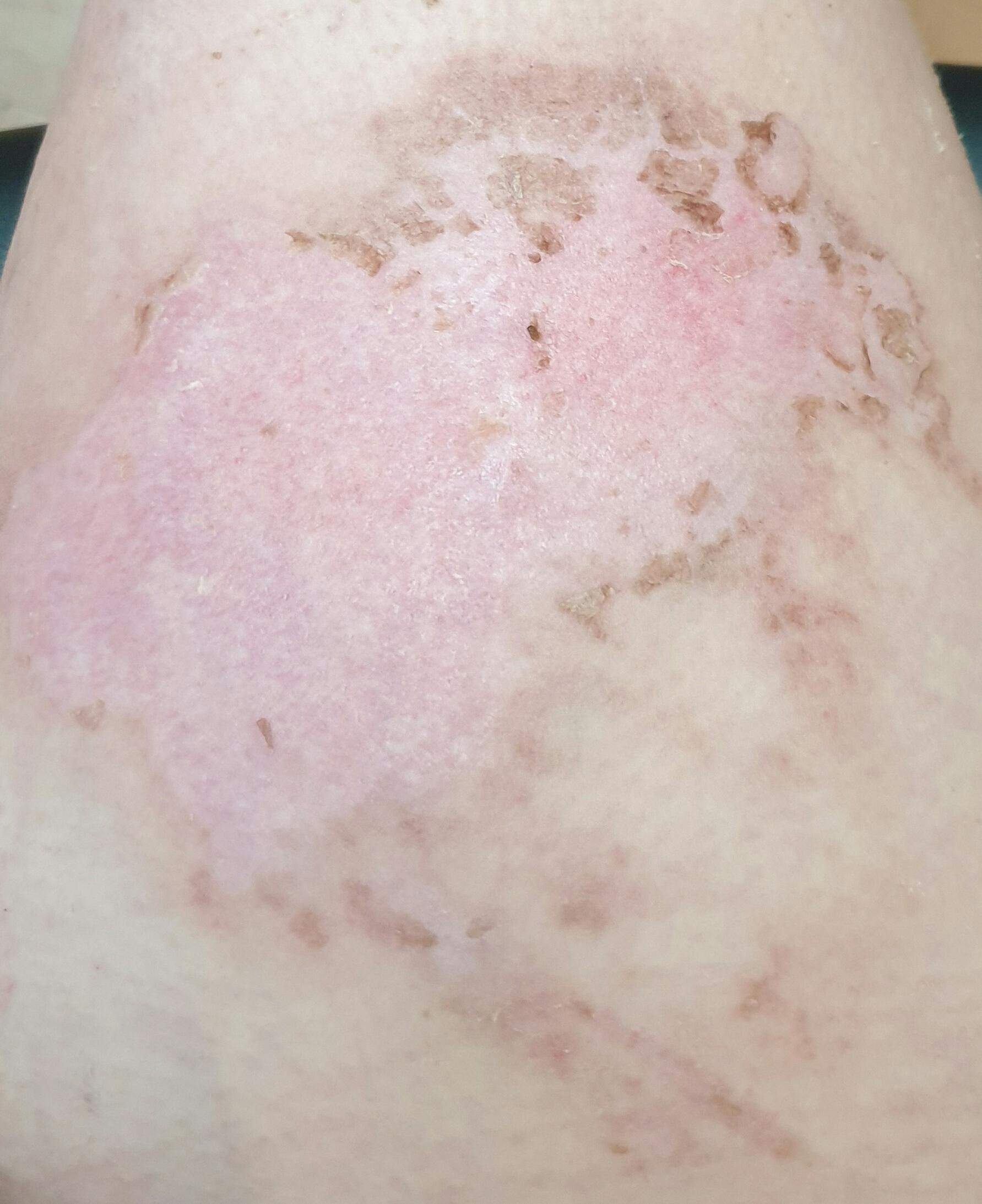 Werden Narben bei dieser Brandwunde bleiben? (Medizin, Verbrennung) Werden Narben bei dieser Brandwunde bleiben? (Medizin, Verbrennung)