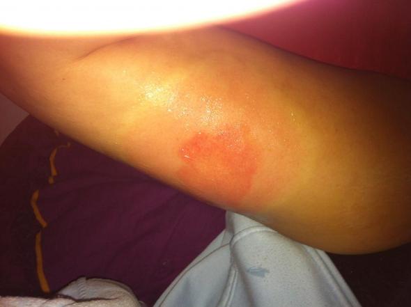 Wespenstich Allergie Nach 24std Schwellung Wespen Wespenstich Allergie Nach 24std Schwellung Wespen