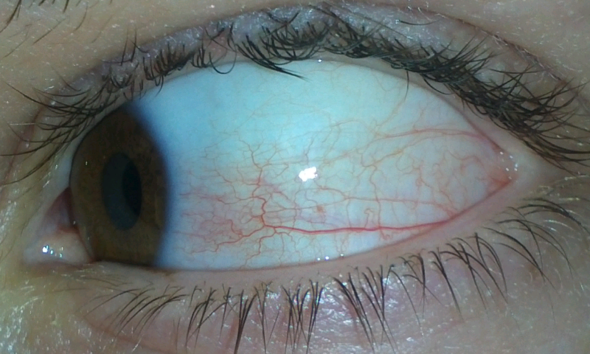 WICHTIG! Mein Auge ist gerötet und tut weh. (Arzt, Augen, Augenarzt)
