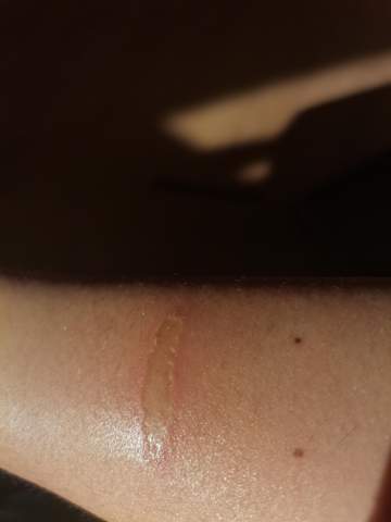 Wie Behandeln Ich Diese Offene Wunde Richtig Gesundheit Und Medizin Offene Wunde Wie Behandeln Ich Diese Offene Wunde Richtig Gesundheit Und Medizin Offene Wunde