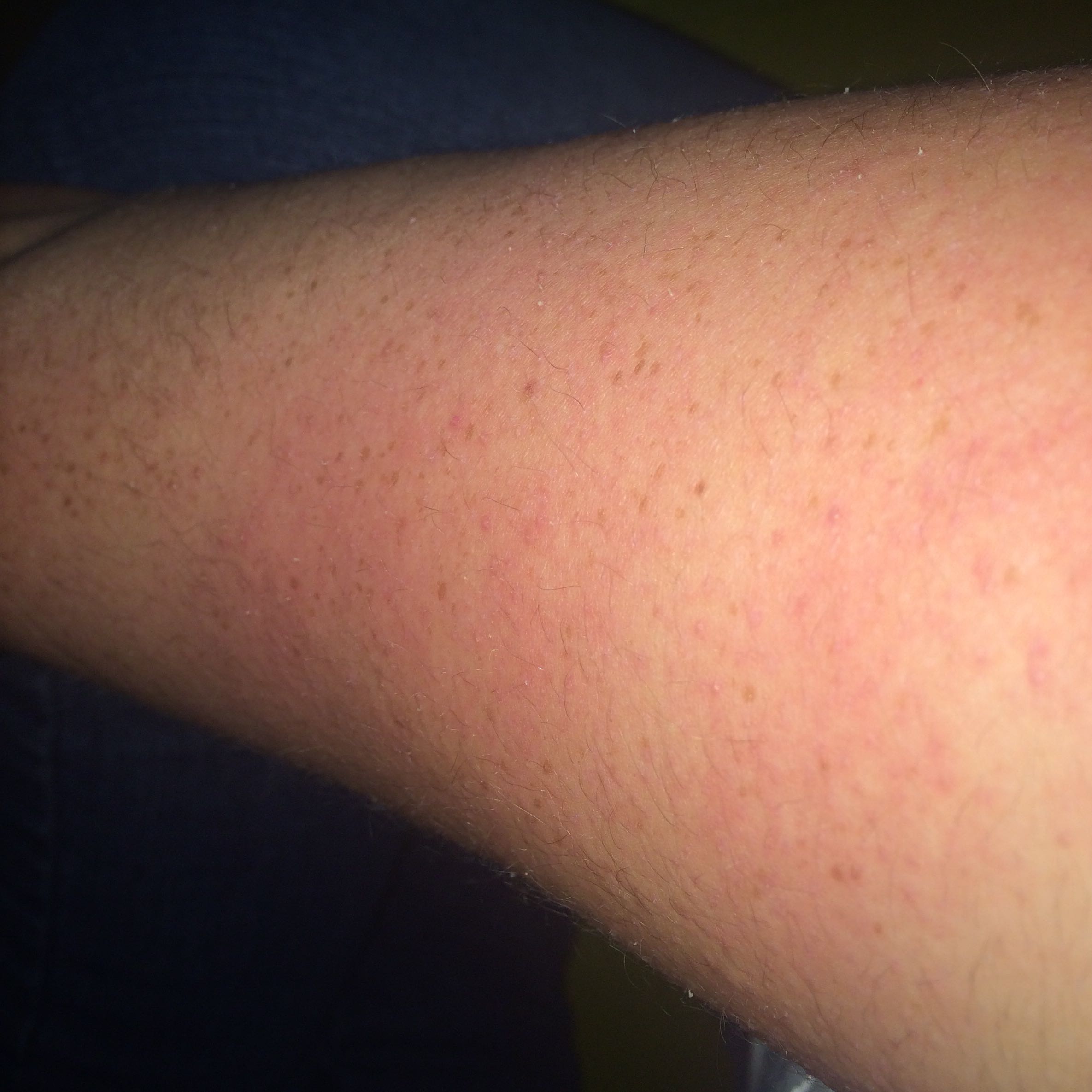 Wie äußert sich der Ausschlag einer Lebensmittelallergie? (Gesundheit Wie äußert sich der Ausschlag einer Lebensmittelallergie? (Gesundheit