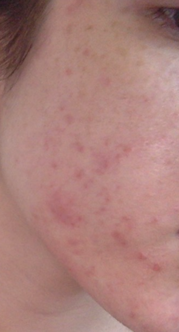 Wie bekämpfe ich schnell und effektiv diese Pickel, Pickelmale und ...