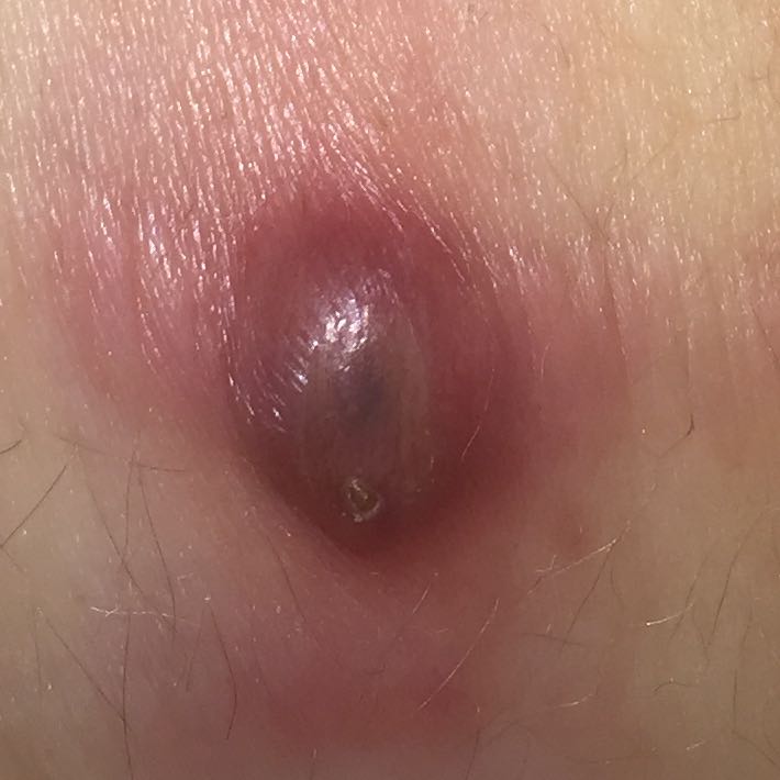 Wie bekomme ich am besten diesen Abszess wieder weg? (Gesundheit