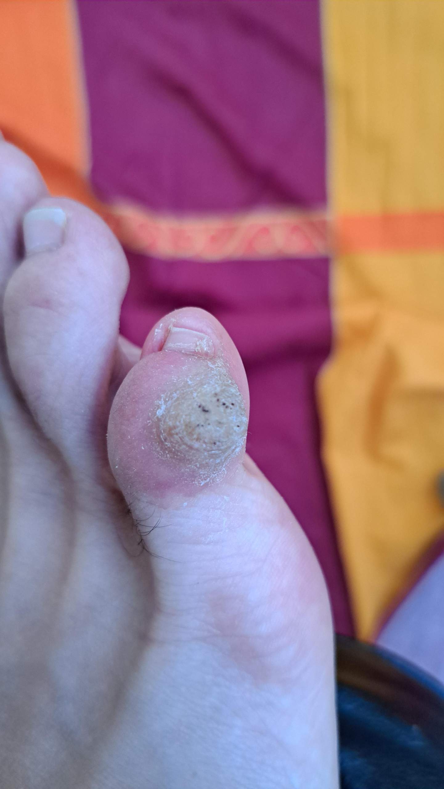 Wie bekomme ich das von meinen rechten kleinen Zeh weg? (Haut, Füße, Hornhaut)