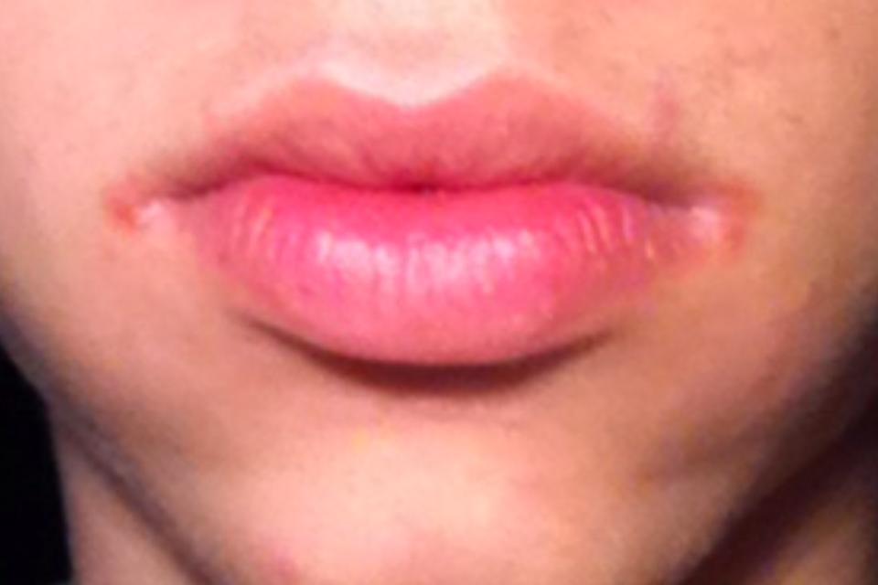 View Pickel Im Mundwinkel Wegbekommen Background