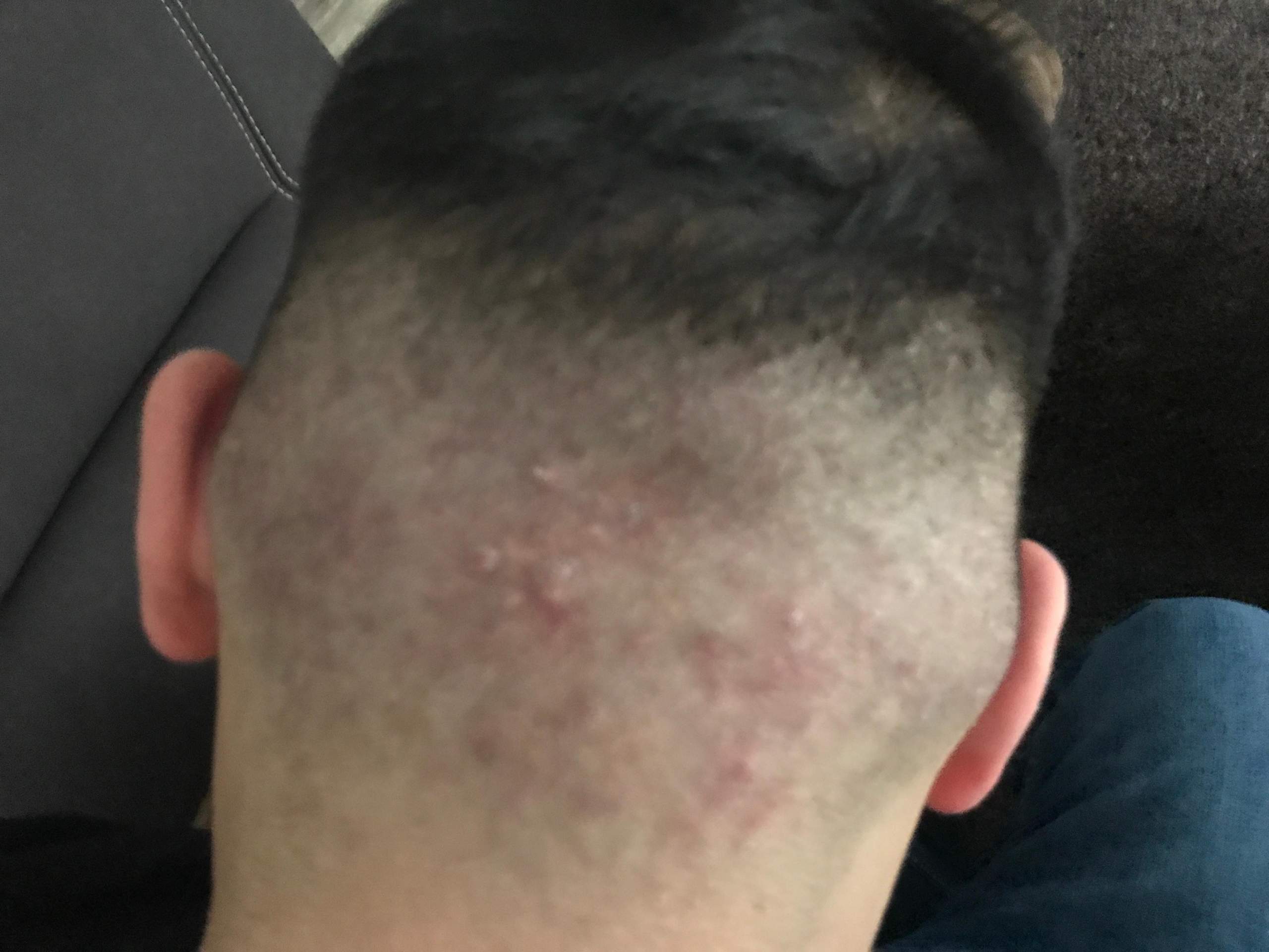 Wie bekomme ich die Pickel am meinen Hinterkopf weg? (Medizin, Haut, Dermatologie) pickel hinterkopf