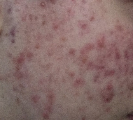 Wie Bekomme Ich Die Rotungen Meiner Pickel Weg Gesundheit Und Medizin Haut Akne