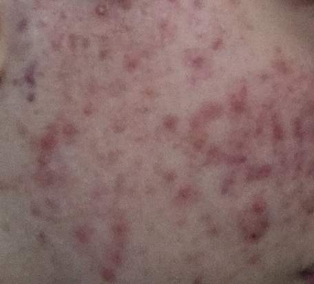 Wie bekomme ich die Rötungen meiner Pickel weg? (Gesundheit und Medizin, Haut, Akne)