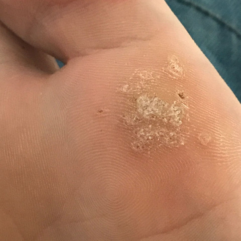 Wie bekomme ich die Warzen schmerzfrei weg? (Krankheit, Haut)