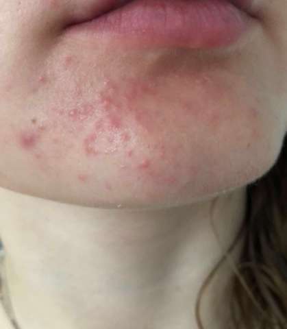 Wie bekomme ich diese kleinen Pickel schnell weg? (Beauty, Haut, Gesicht) pickel jucken kinn