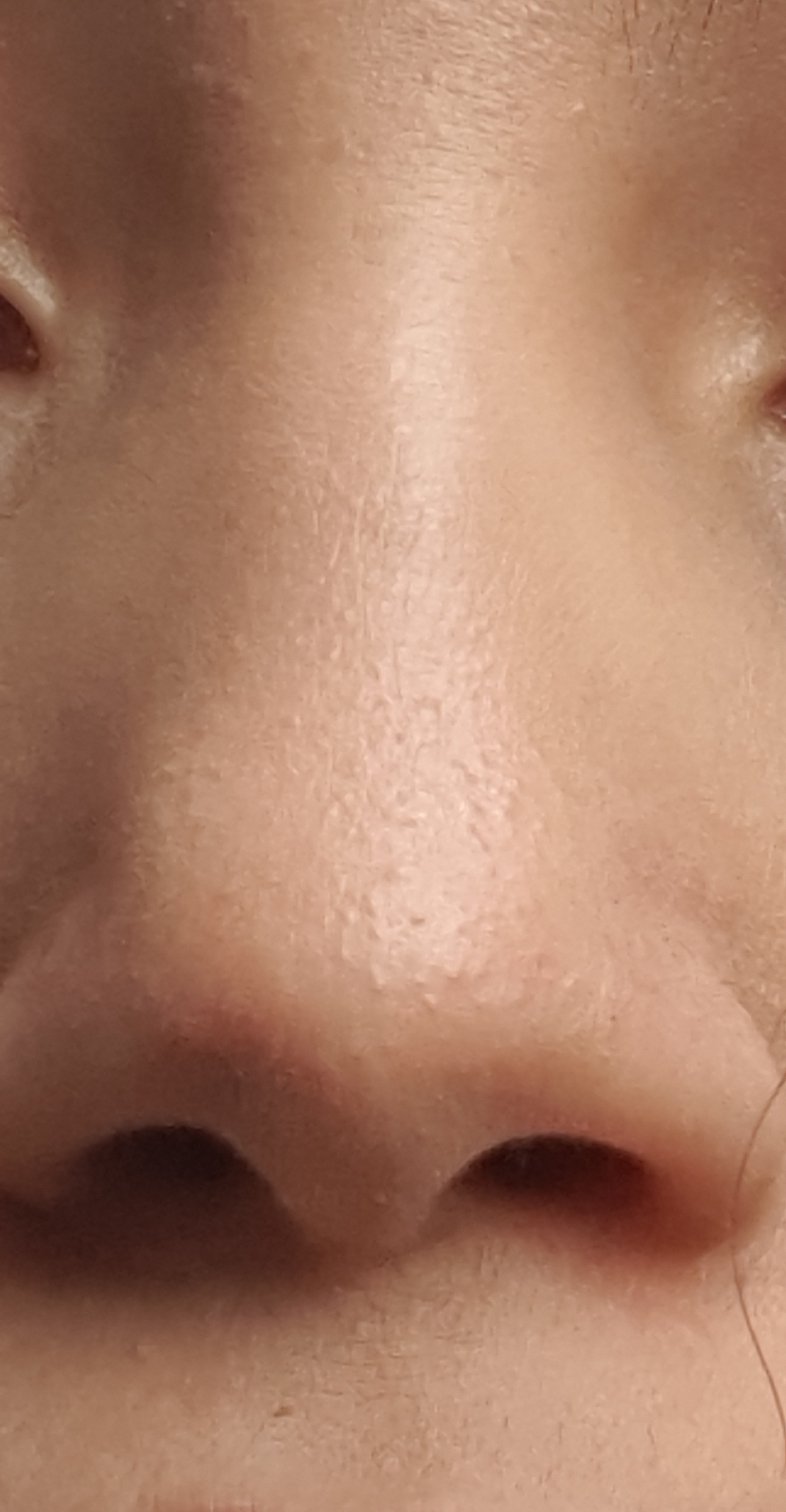 Wie bekomme ich diese pickel auf der nase weg? pickel auf der nase