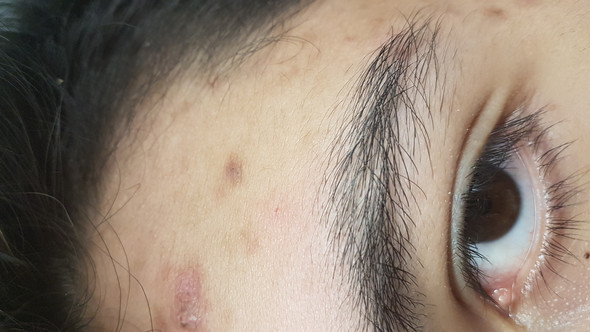 Wie Bekomme Ich Pickelnarben Braune Flecke Aus Dem Gesicht Gesundheit Und Medizin Medizin Arzt