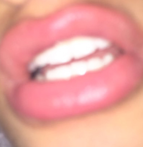 Lippen - (Schönheit, Operation, Lippe)