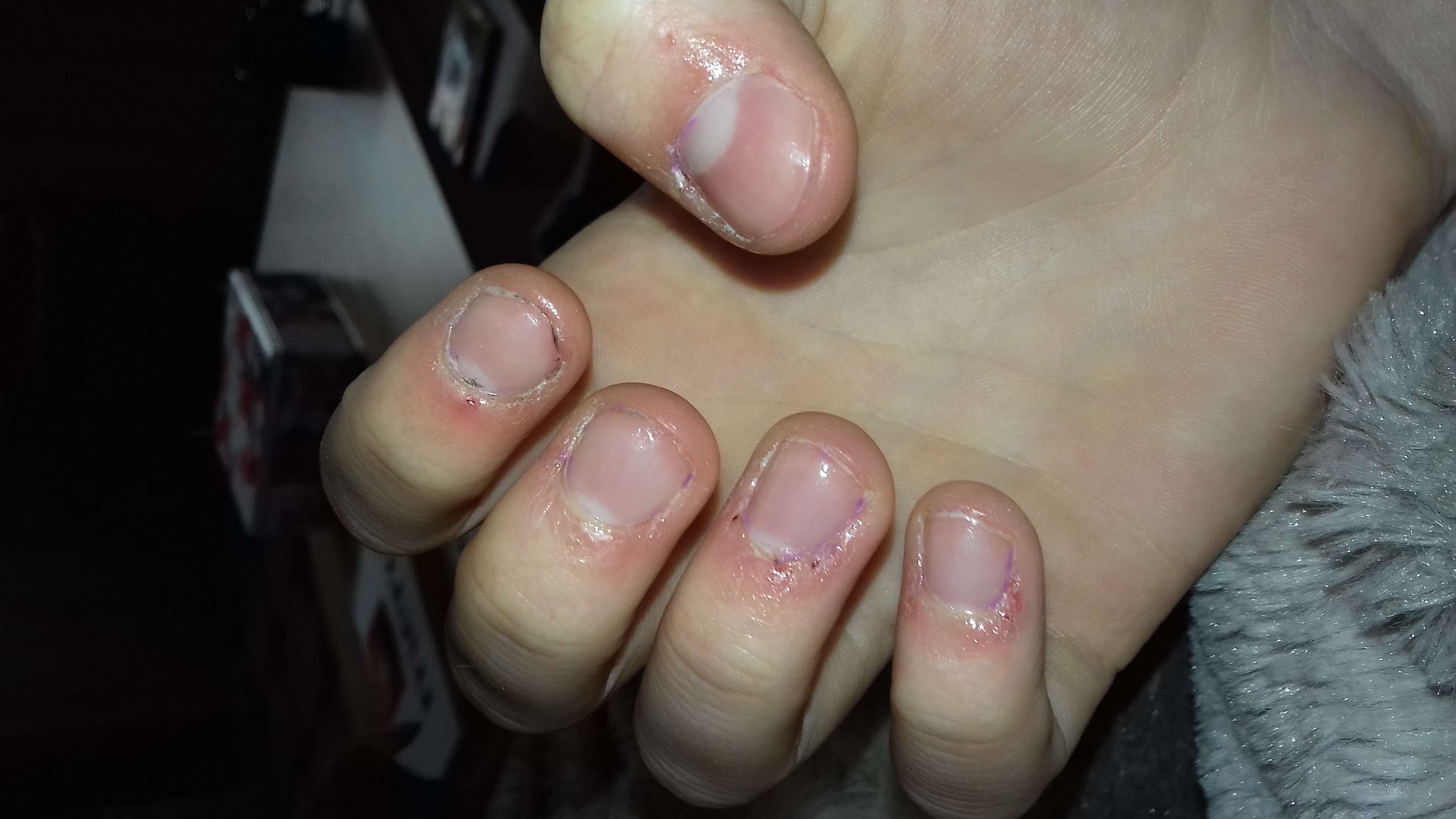 Wie bekomme ich wieder Schöne Fingernägel und Nagelhaut nach 5 Jahren Nägelkauen? (fingernägel Wie bekomme ich wieder Schöne Fingernägel und Nagelhaut nach 5 Jahren Nägelkauen? (fingernägel