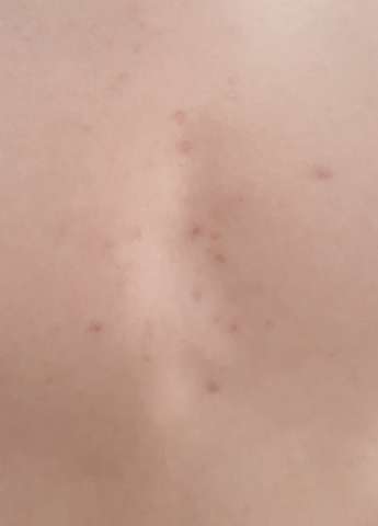 Wie Bekommt Man Die Pickel Narben Weg Wie Bekommt Man Die Pickel Narben Weg