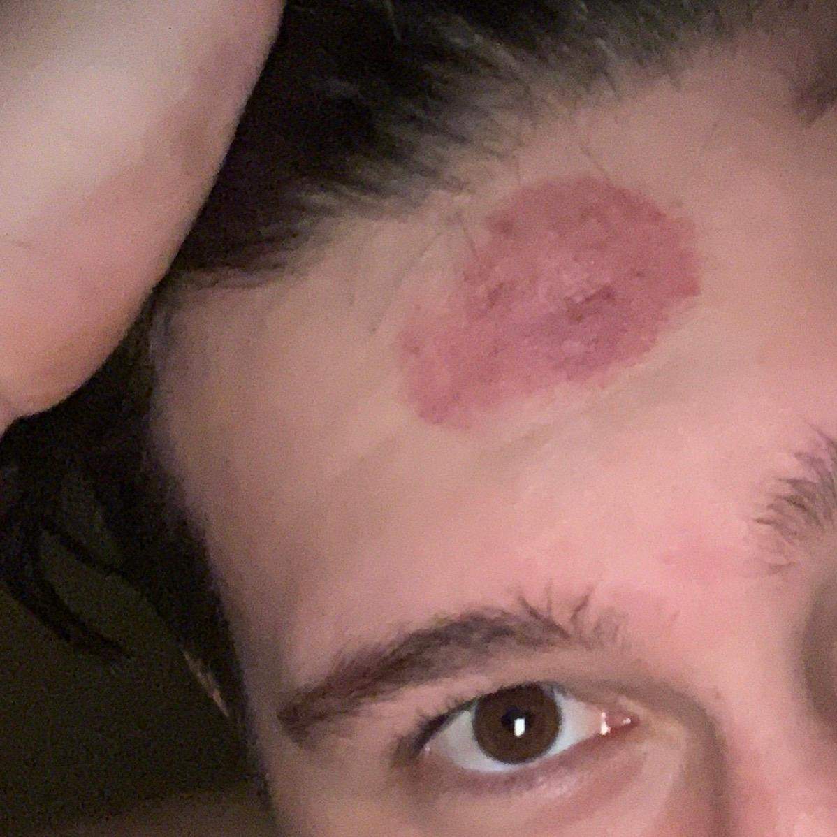 Wie bekommt man Knutschflecken wieder weg? (Haut, Knutschfleck)