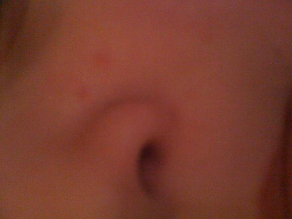 Wie Bekommt Man Pickel Uber Nacht Weg Ih Wie Bekommt Man Pickel Uber Nacht Weg Ih