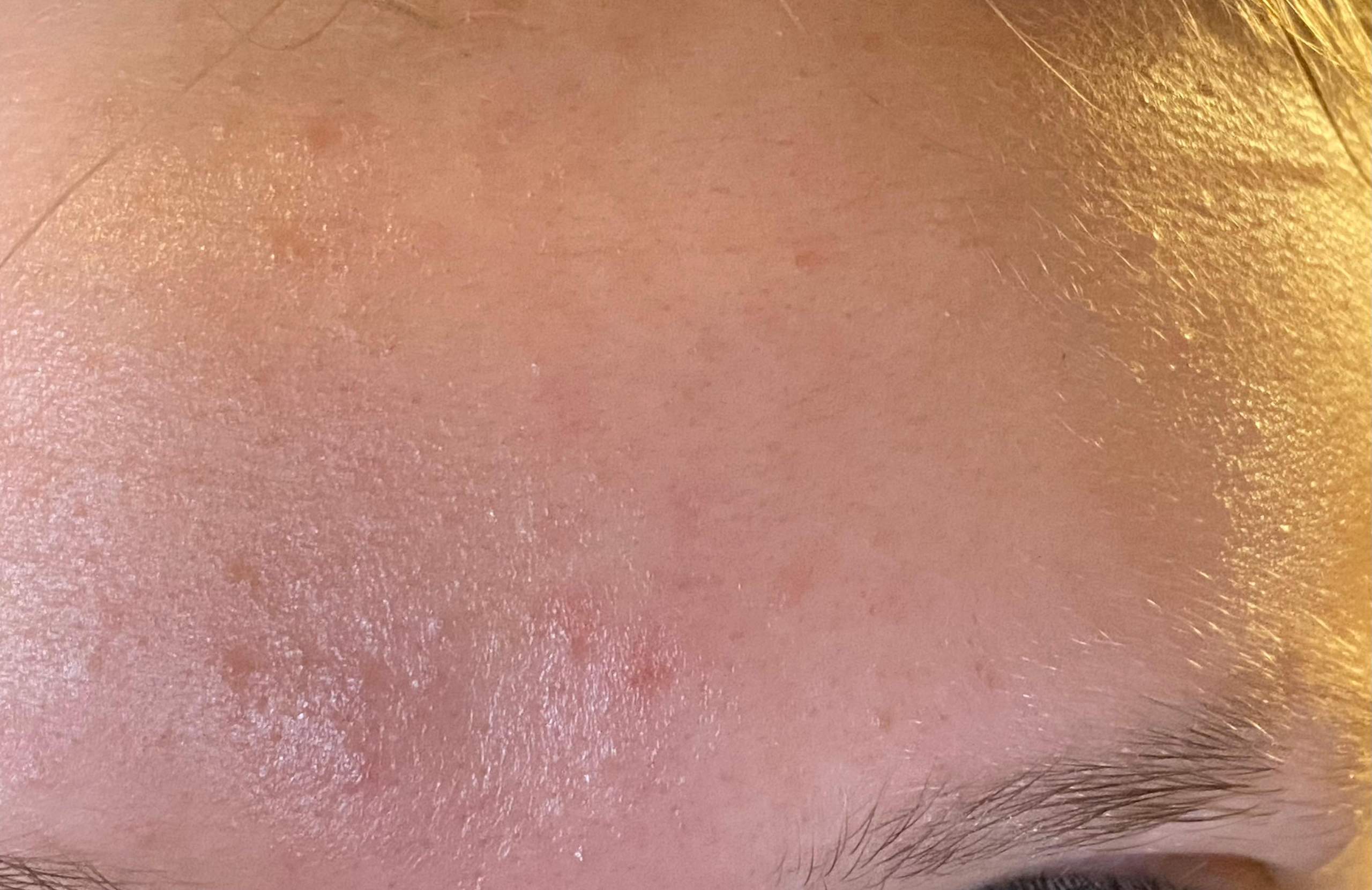 Wie Bekommt Man Filzstift Von Der Haut Wie bekommt man solche Picke auf der Stirn weg? (Mädchen, Haut, Pflege)