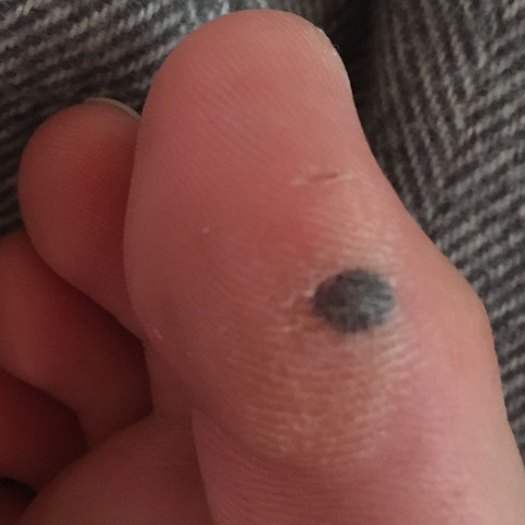 Wie Blutblase Behandeln Gesundheit Fusse Blut Wie Blutblase Behandeln Gesundheit Fusse Blut