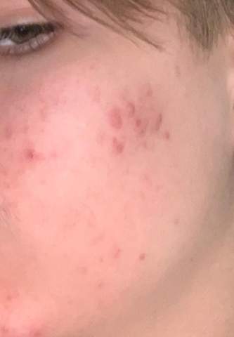 Wie Bekomme Ich Diese Pickel Weg Gesundheit Und Medizin Pubertat Hautpflege Wie Bekomme Ich Diese Pickel Weg Gesundheit Und Medizin Pubertat Hautpflege